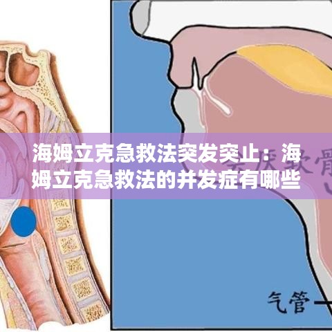 海姆立克急救法突發突止：海姆立克急救法的并發癥有哪些? 