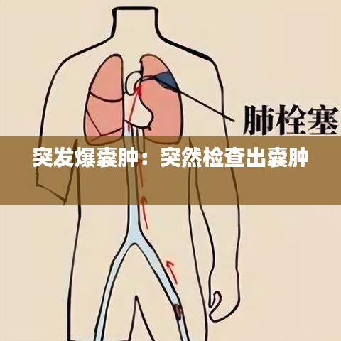 突發爆囊腫:突然檢查出囊腫