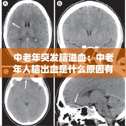 中老年突發腦溢血：中老年人腦出血是什么原因有哪些 