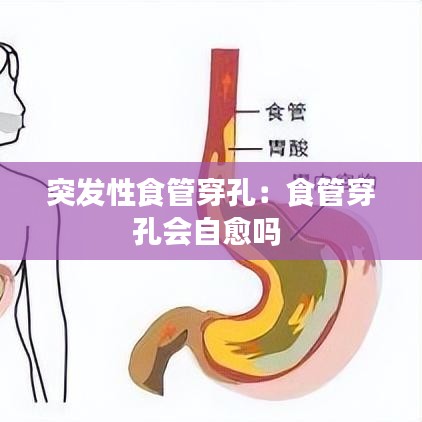 突發(fā)性食管穿孔:食管穿孔會(huì)自愈嗎