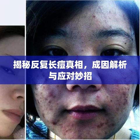 揭秘反復(fù)長(zhǎng)痘真相,成因解析與應(yīng)對(duì)妙招