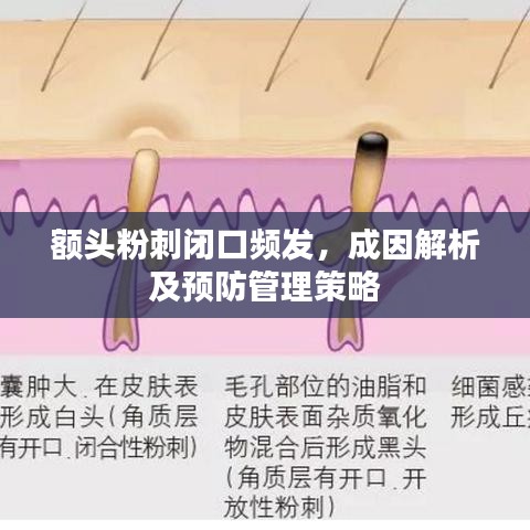 額頭粉刺閉口頻發(fā),成因解析及預防管理策略
